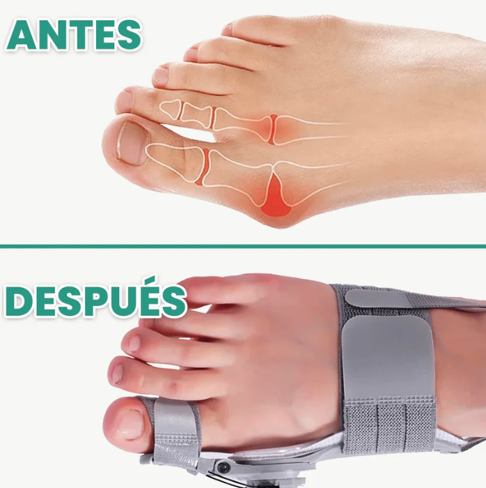 Corrector de Juanetes con Alivio del Dolor - Cómodo y Ajustable